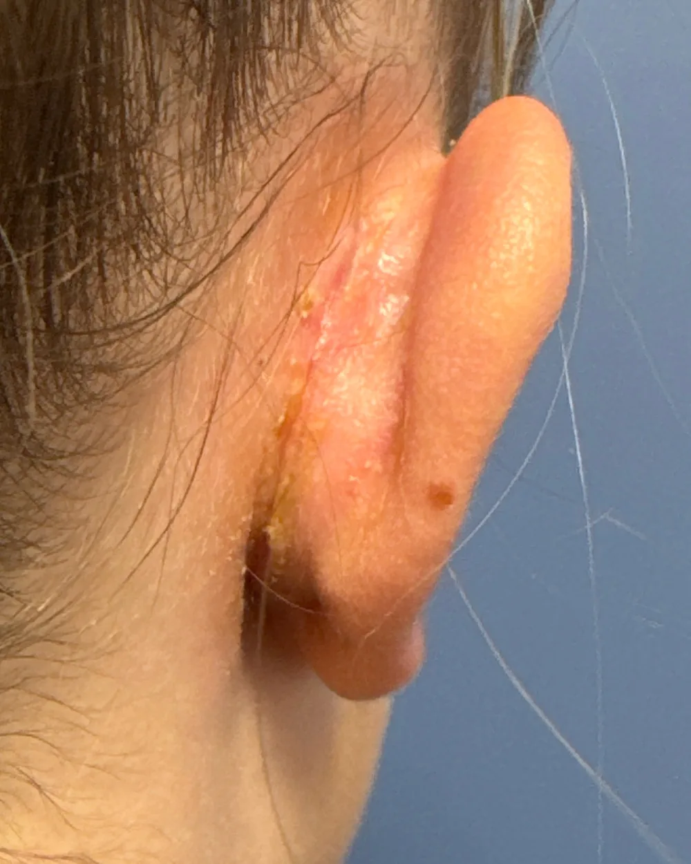 Behind the right ear, after surgery