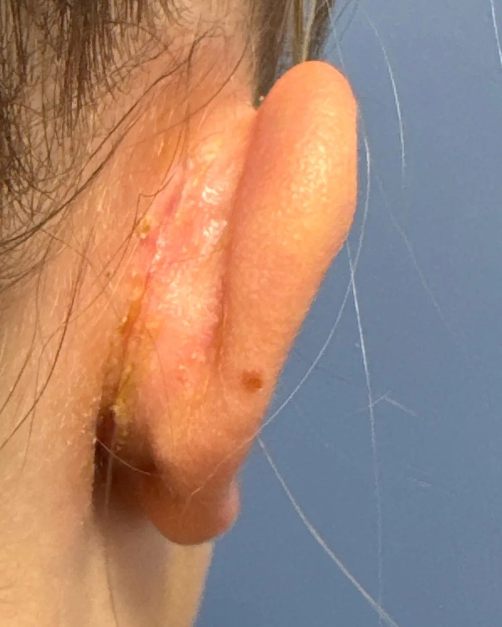 Behind the right ear, after surgery
