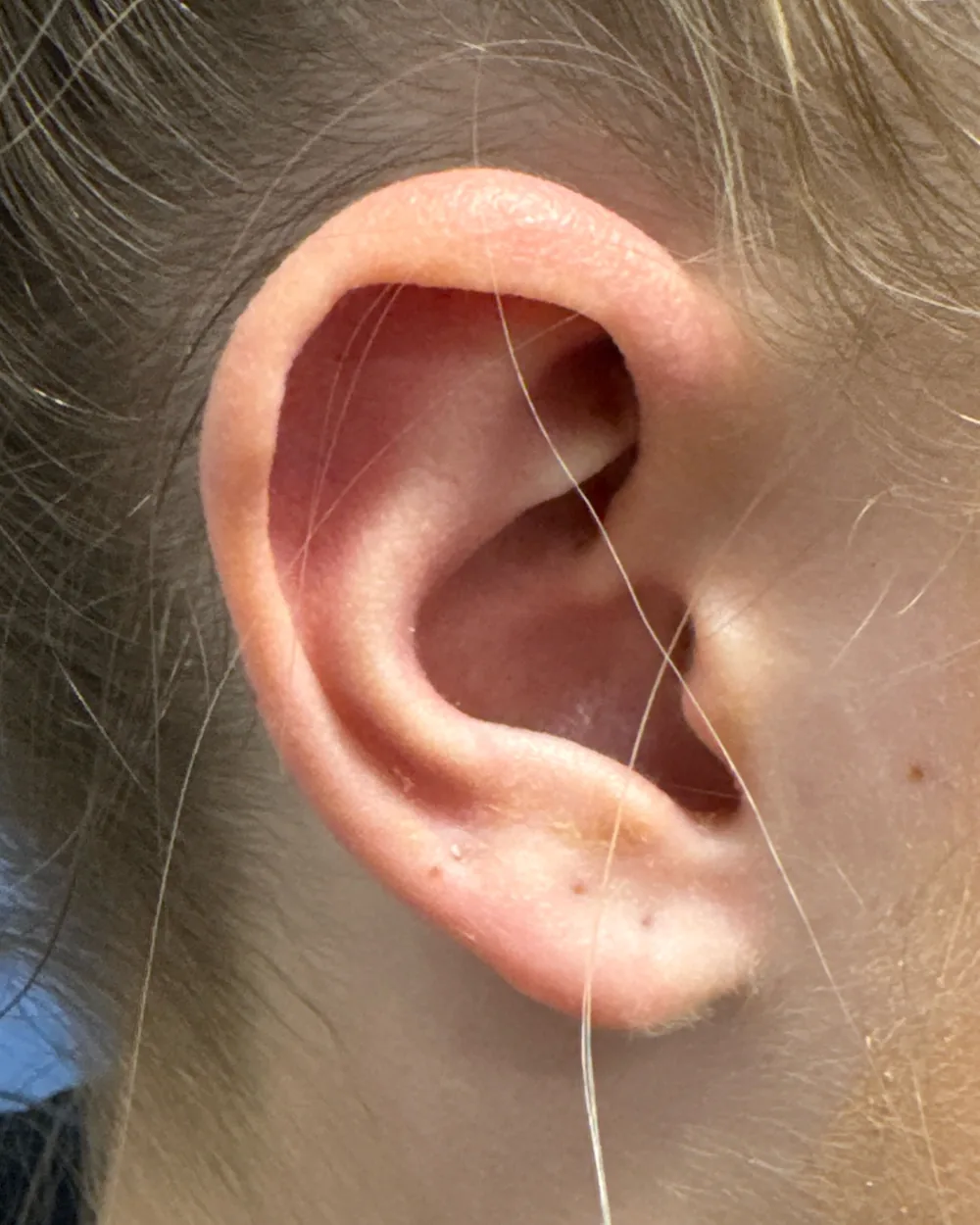 Right ear, from the side, after surgery