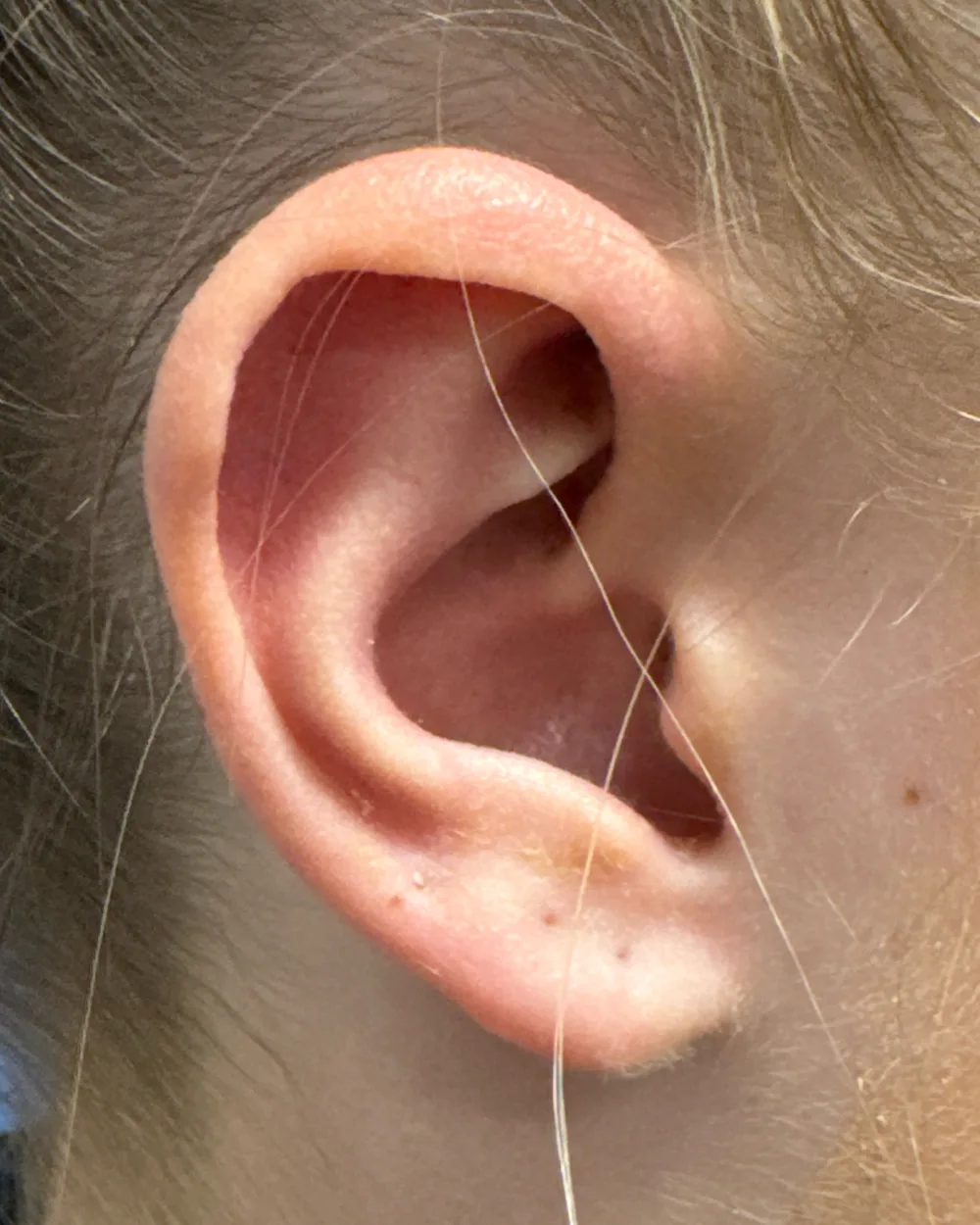 Right ear, from the side, after surgery