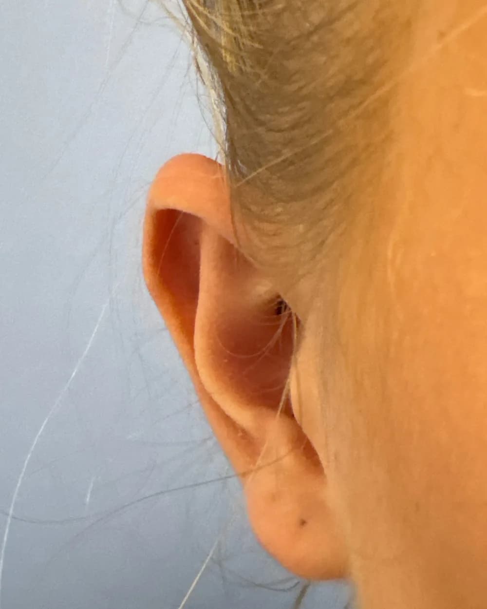 Right ear, from the front, after surgery
