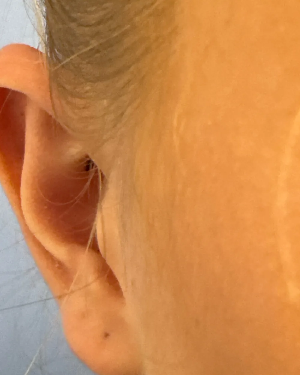 Right ear, from the front, after surgery
