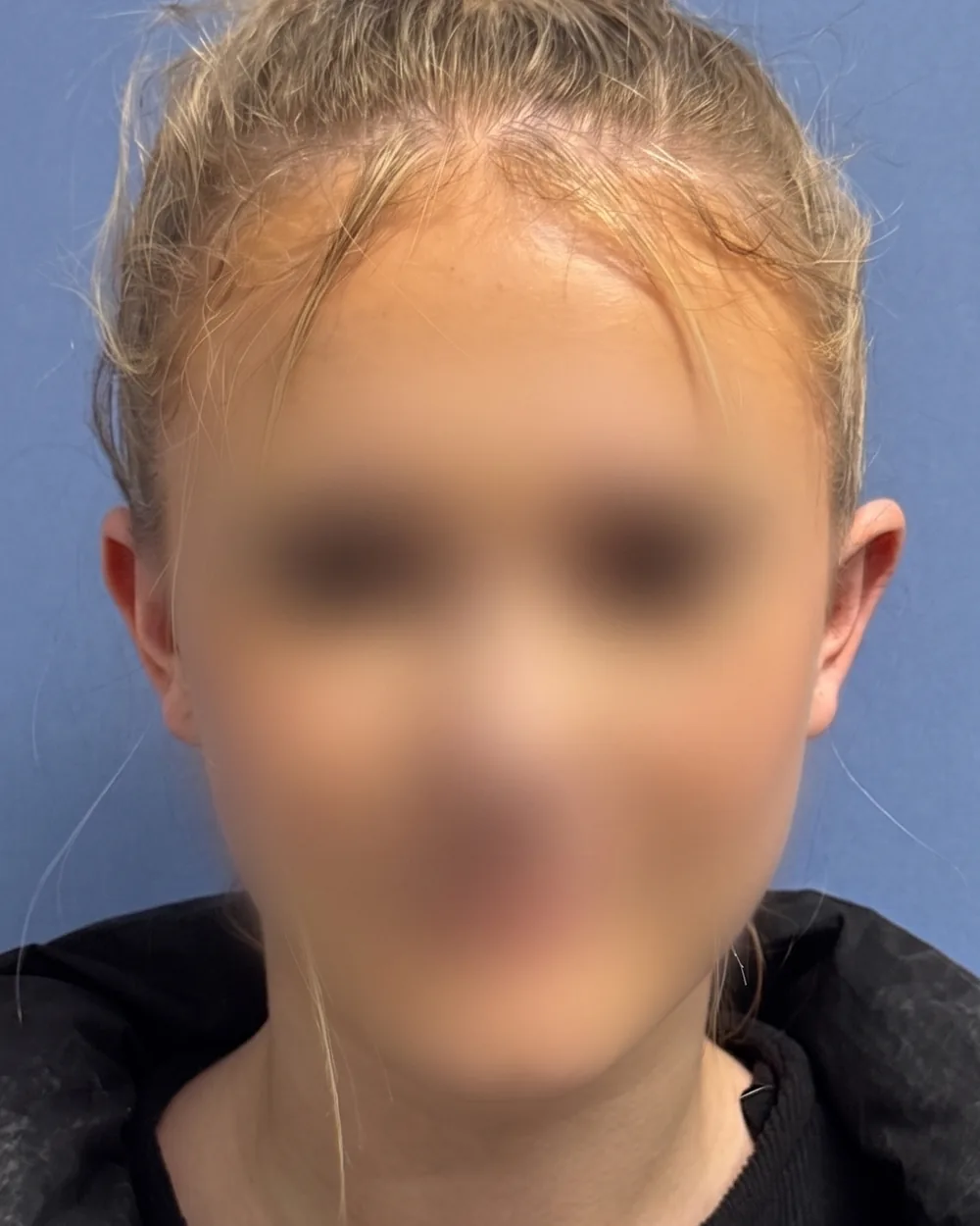 Face on, after surgery