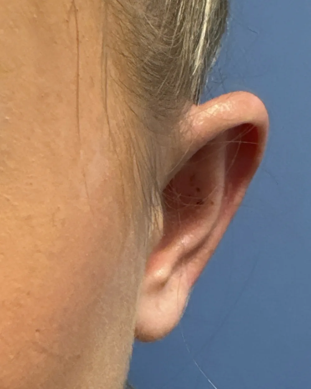 Left ear, from the front, after surgery