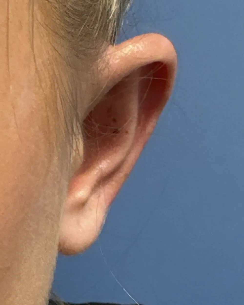 Left ear, from the front, after surgery