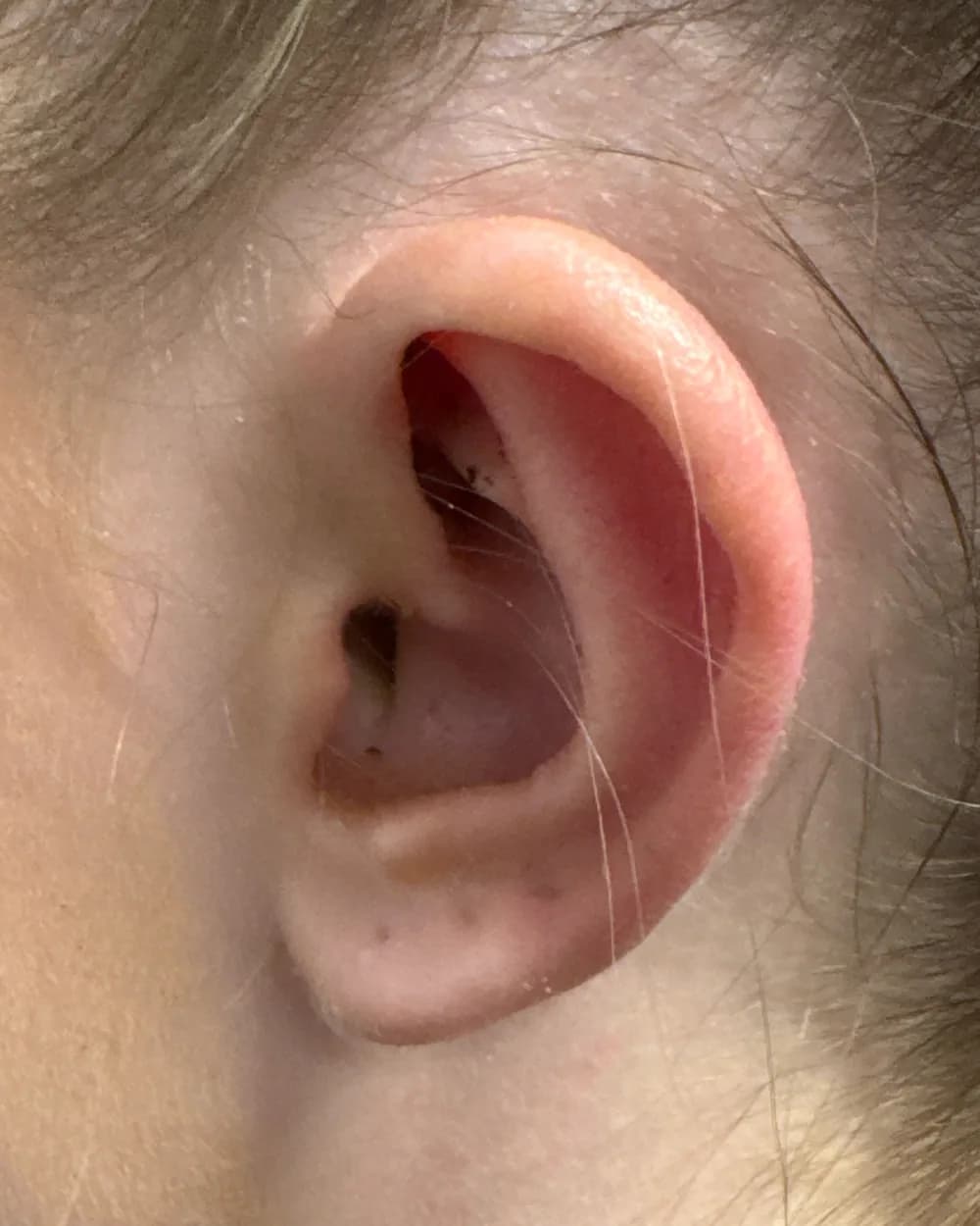 Left ear, from the side, after surgery