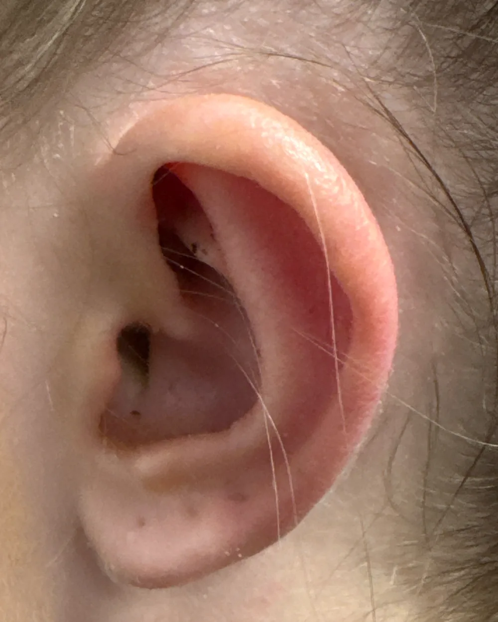 Left ear, from the side, after surgery
