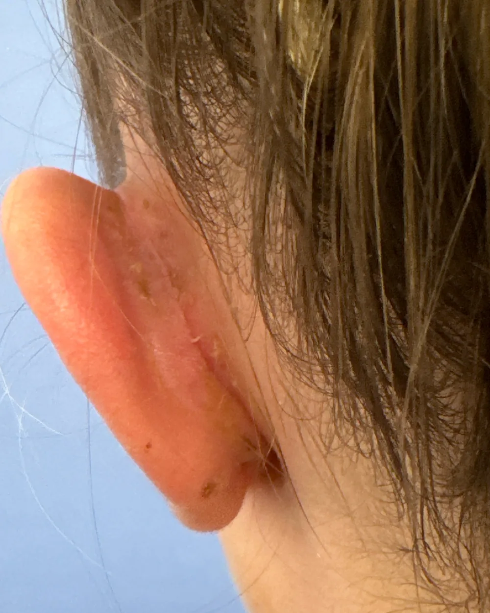 Behind the left ear, after surgery