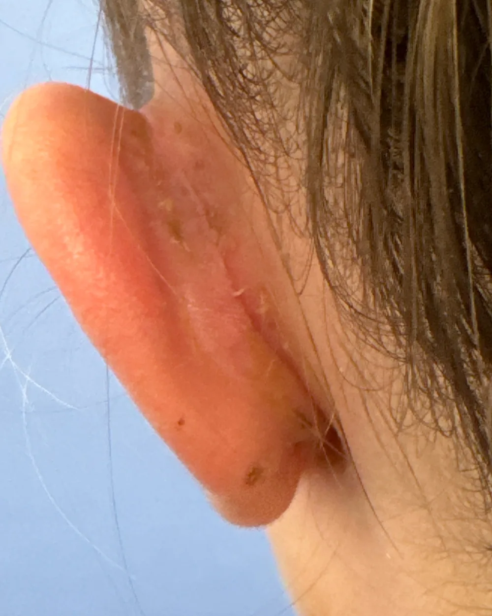 Behind the left ear, after surgery