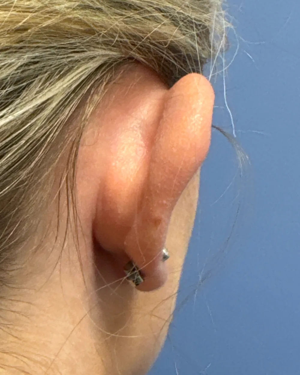 Behind the right ear, before surgery