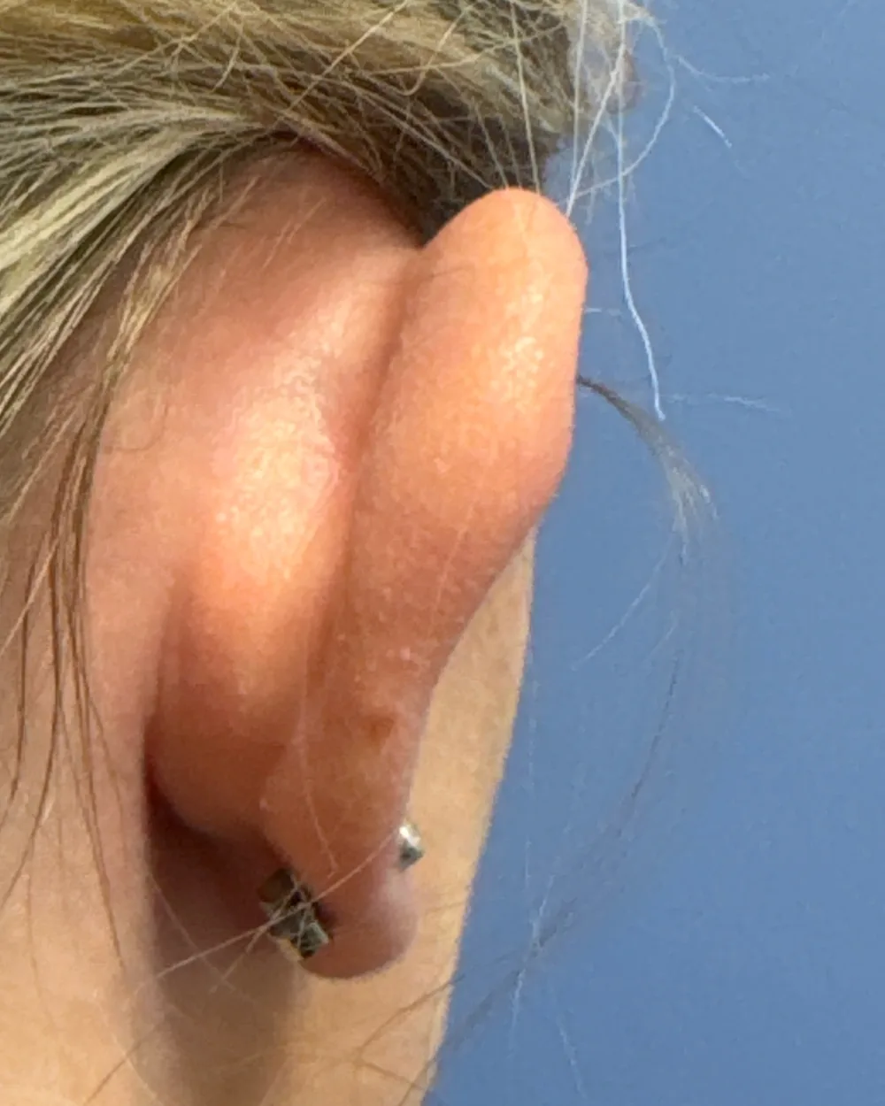 Behind the right ear, before surgery