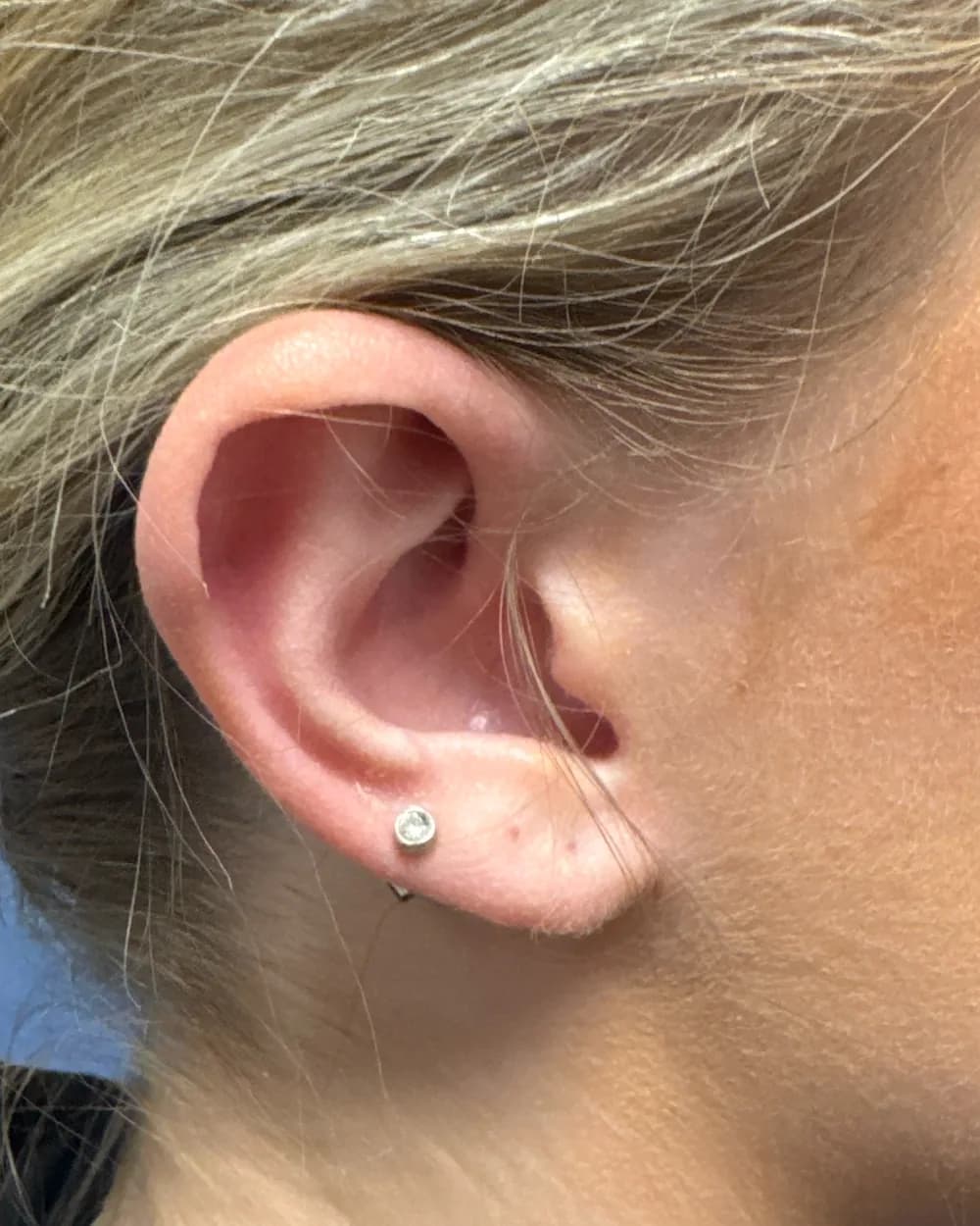 Right ear, from the side, before surgery