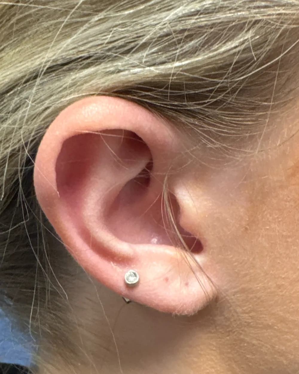 Right ear, from the side, before surgery
