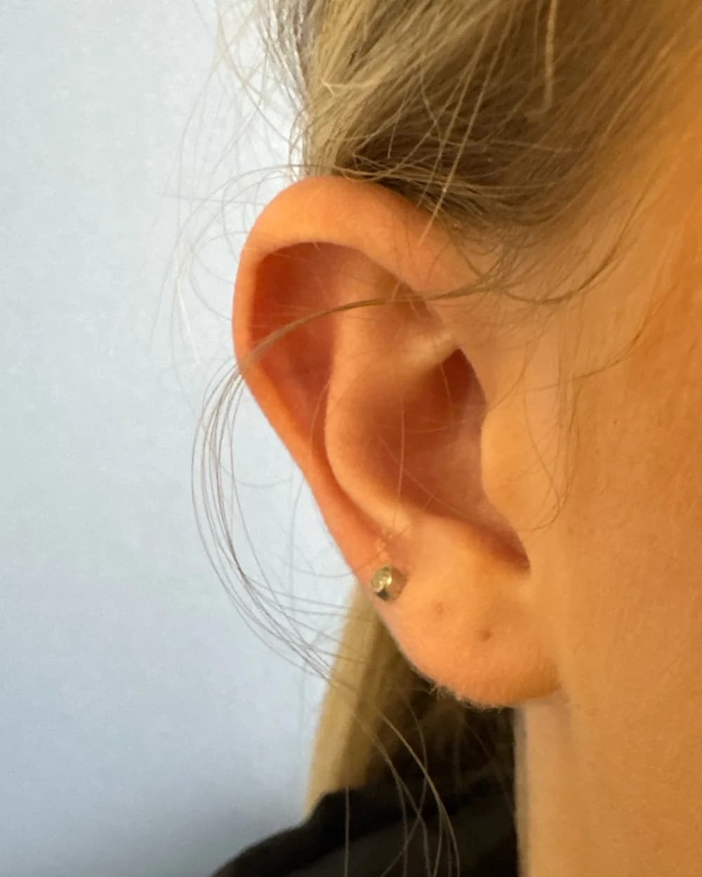 Right ear, from the front, before surgery