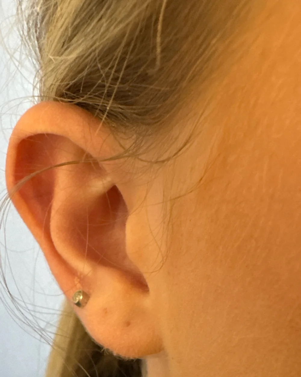 Right ear, from the front, before surgery