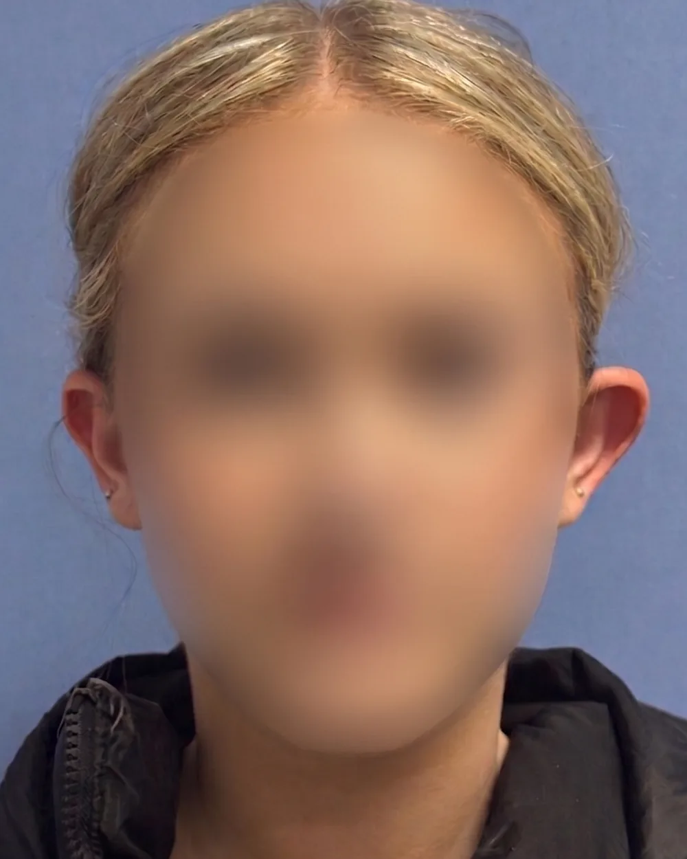 Face on, before surgery