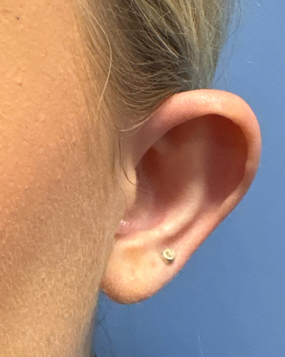 Left ear, from the front, before surgery
