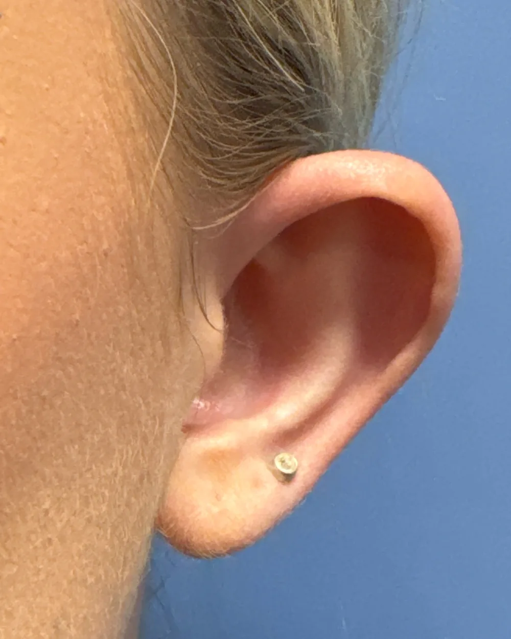 Left ear, from the front, before surgery