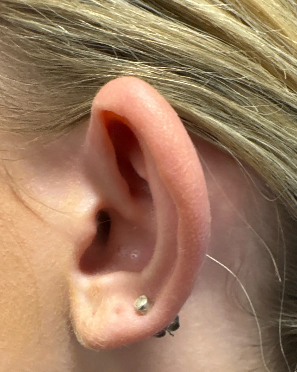 Left ear, from the side, before surgery