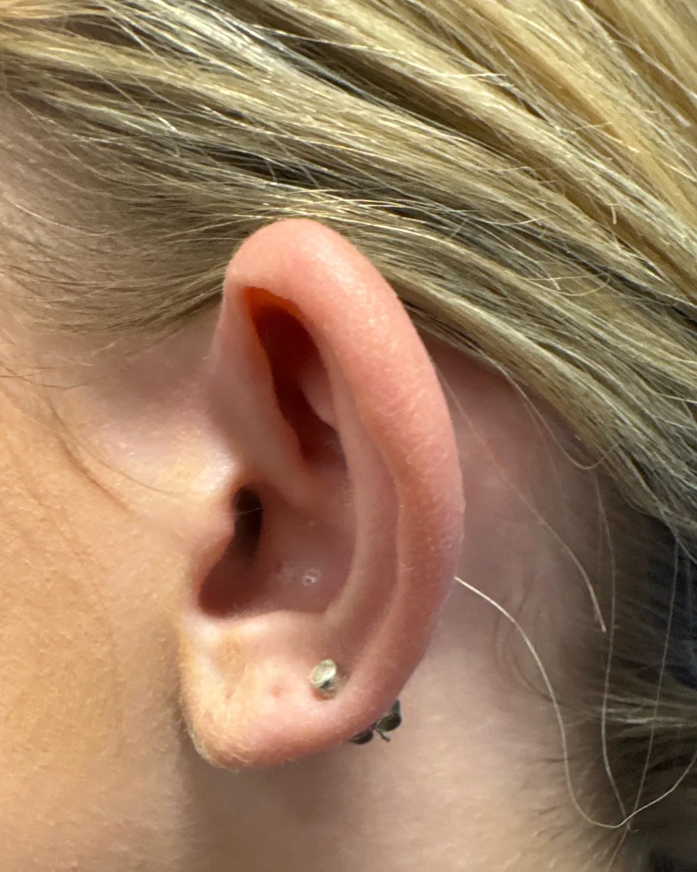 Left ear, from the side, before surgery
