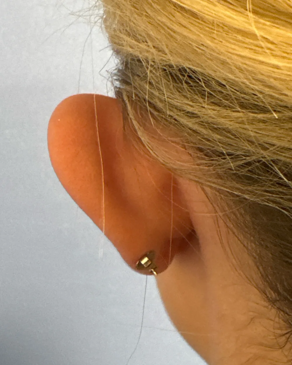 Behind the left ear, before surgery