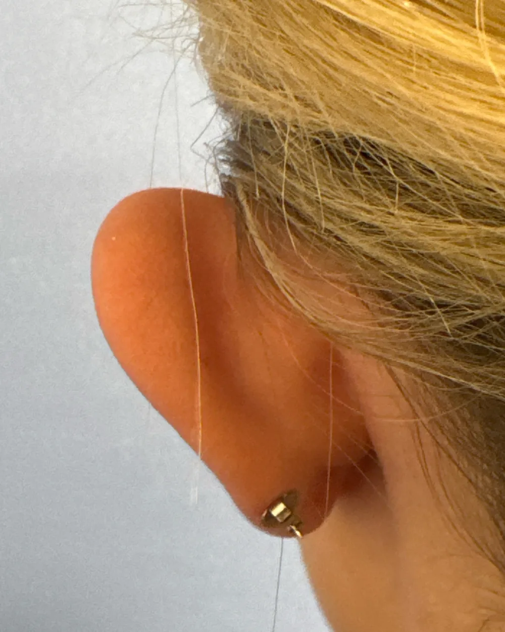 Behind the left ear, before surgery