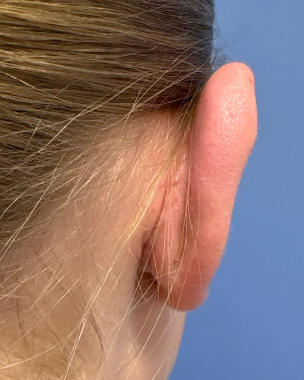 Behind the right ear, after surgery