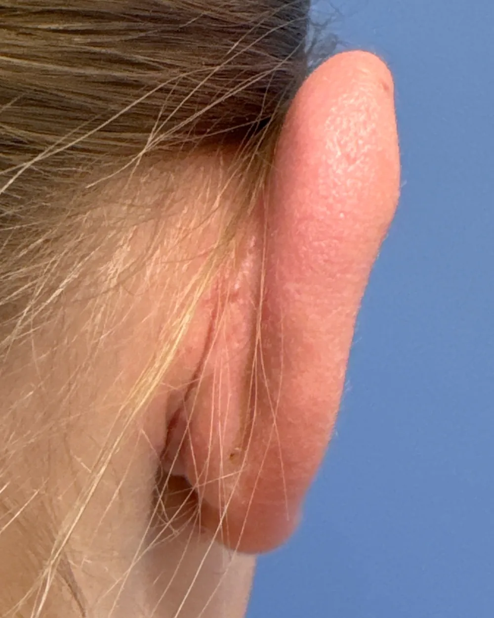 Behind the right ear, after surgery
