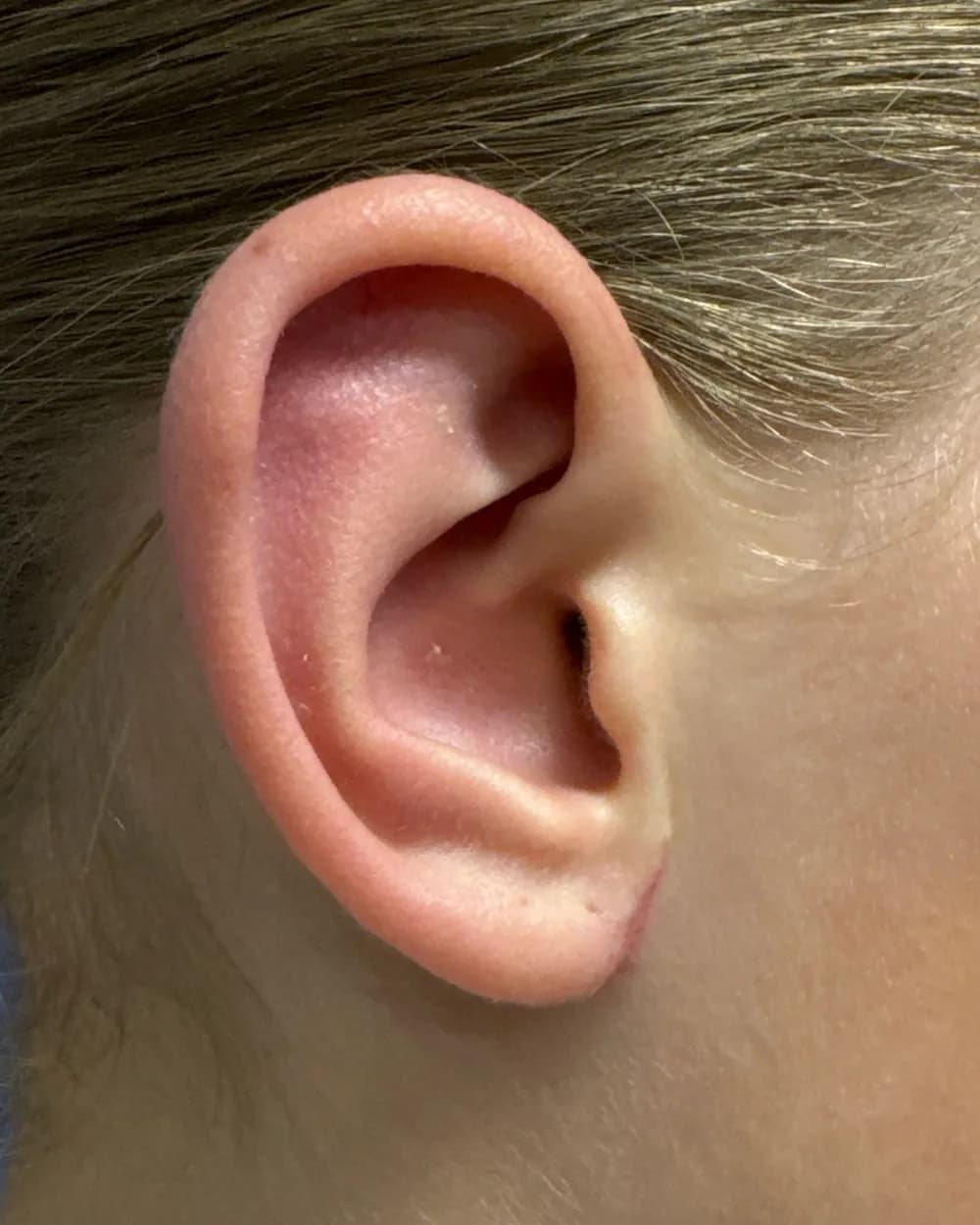 Right ear, from the side, after surgery