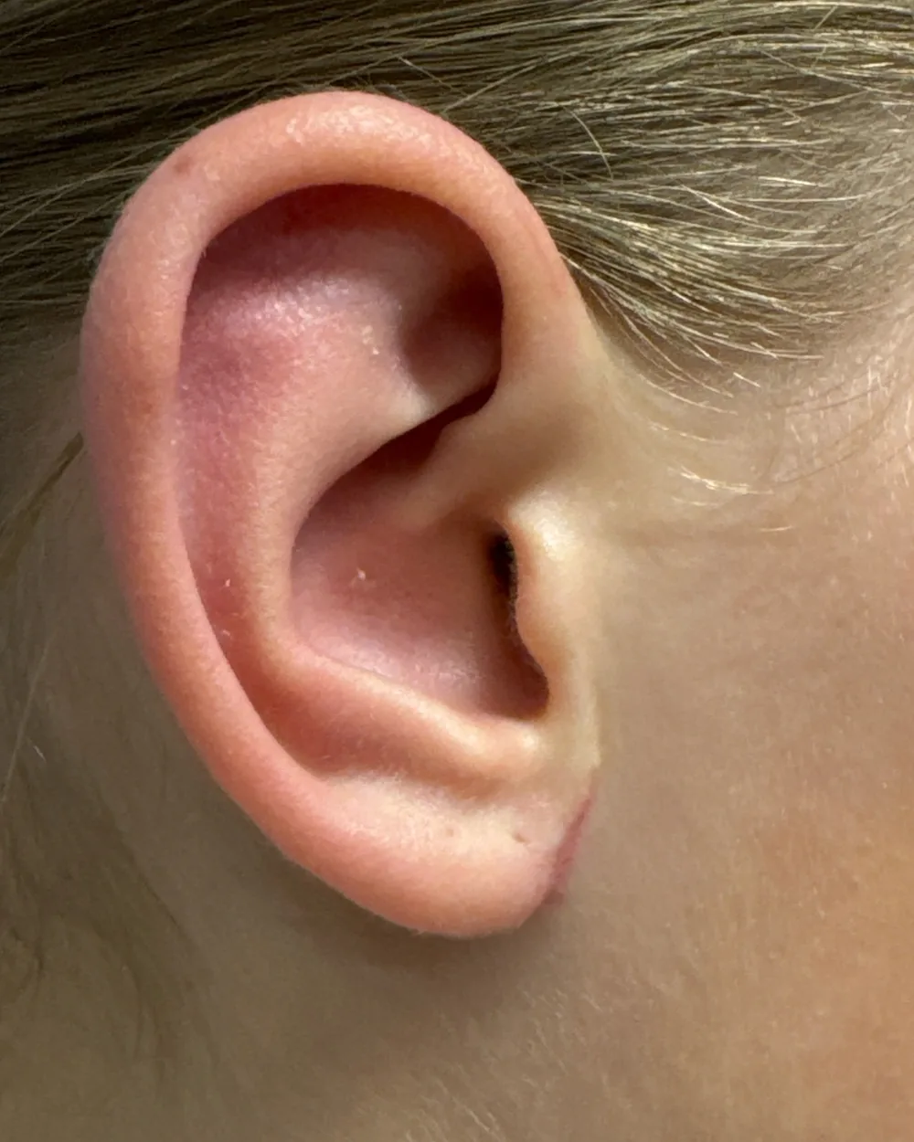 Right ear, from the side, after surgery