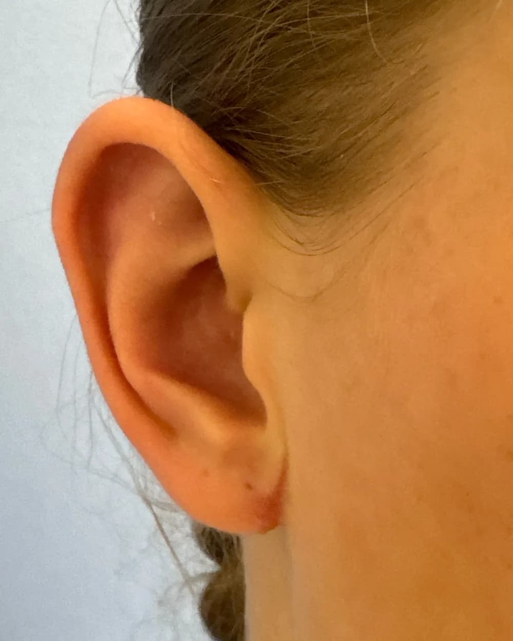 Right ear, from the front, after surgery