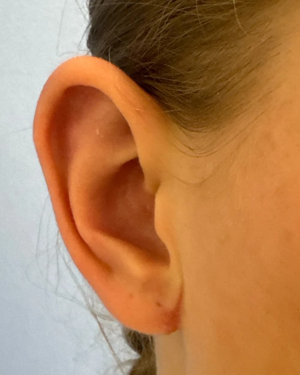 Right ear, from the front, after surgery