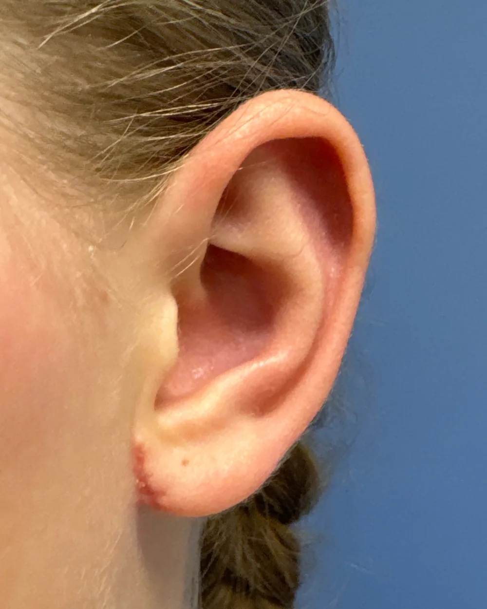Left ear, from the front, after surgery