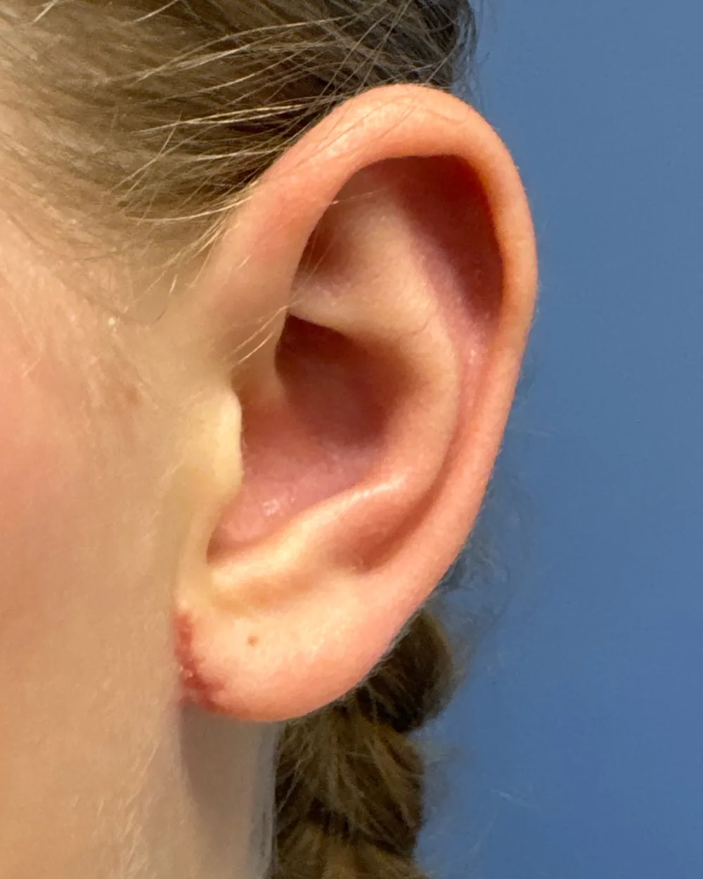 Left ear, from the front, after surgery