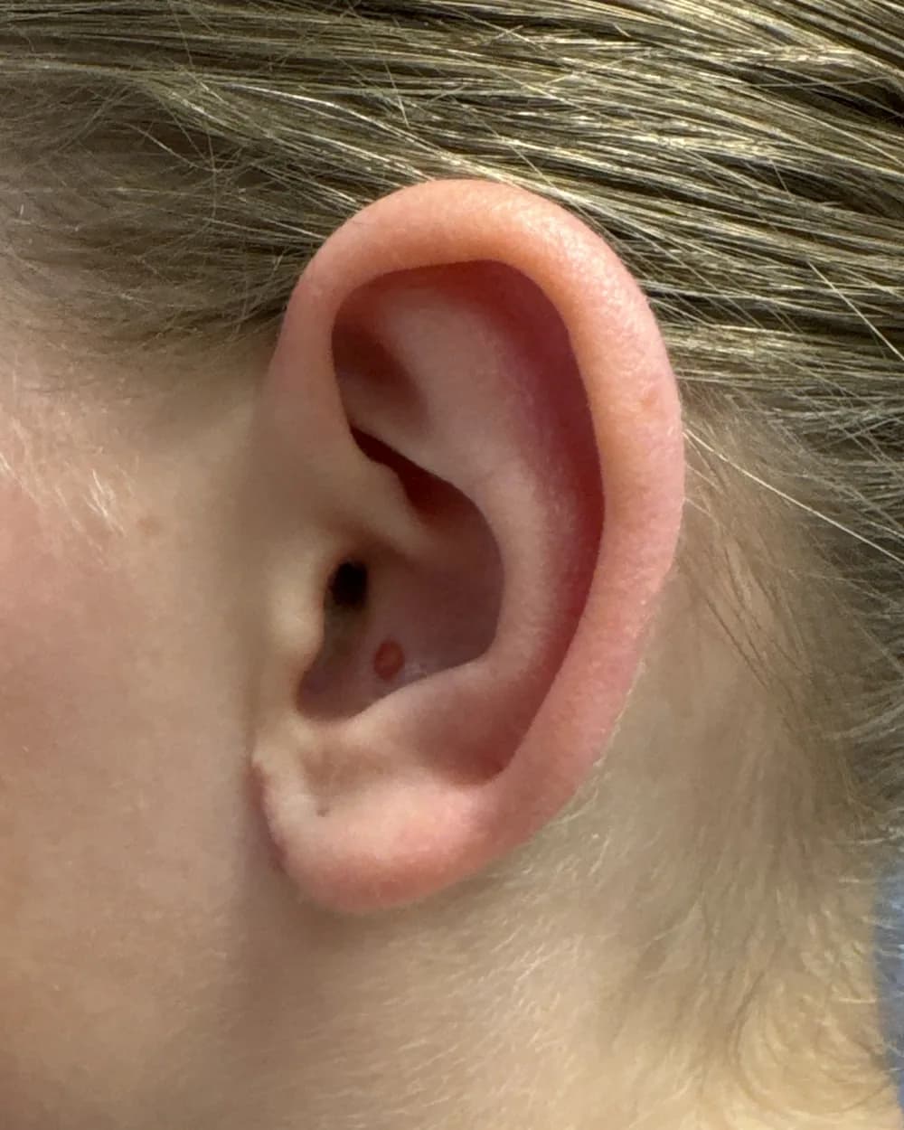 Left ear, from the side, after surgery