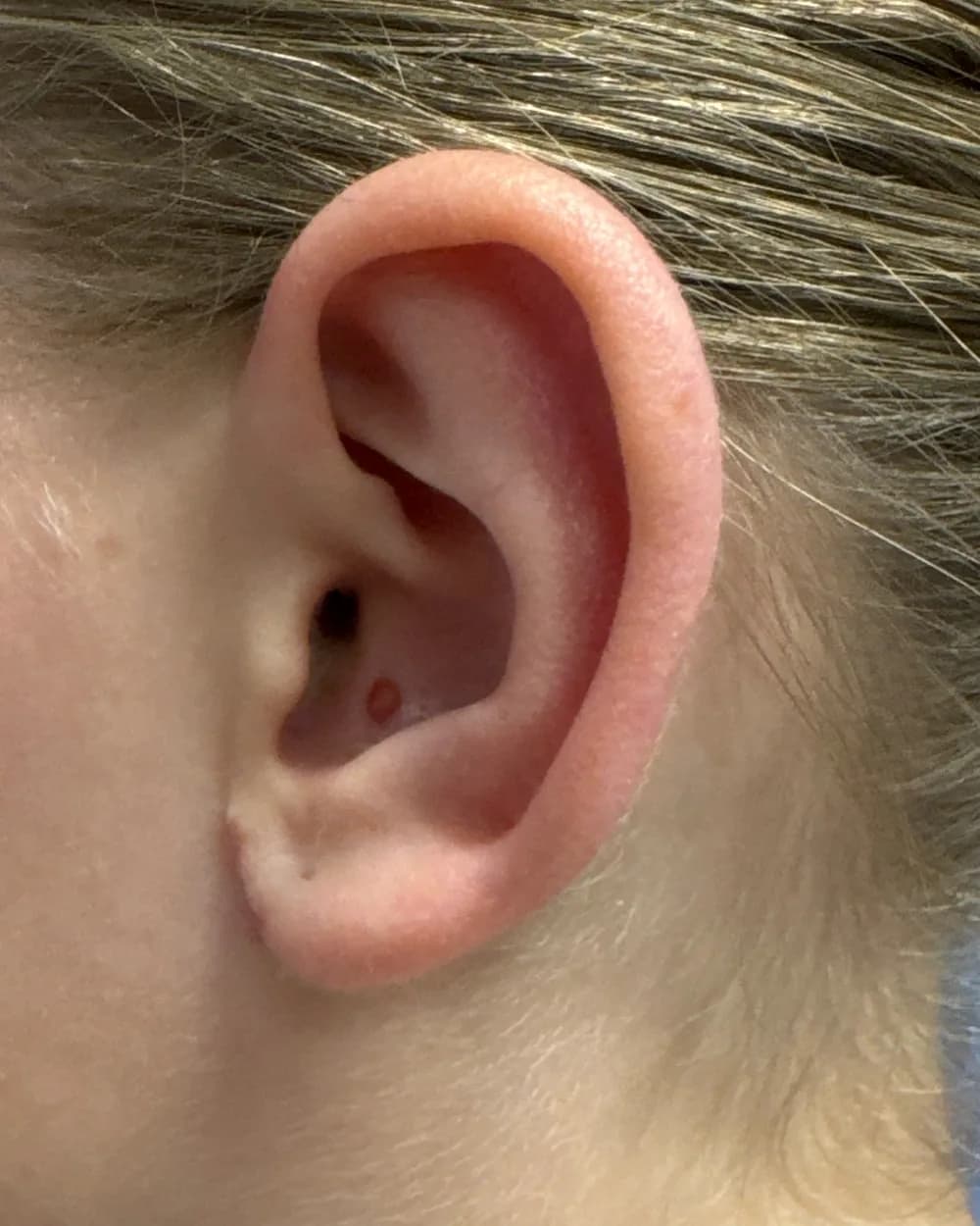 Left ear, from the side, after surgery