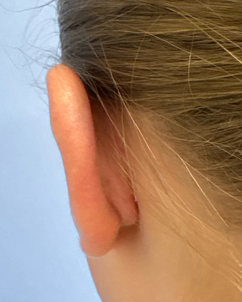 Behind the left ear, after surgery