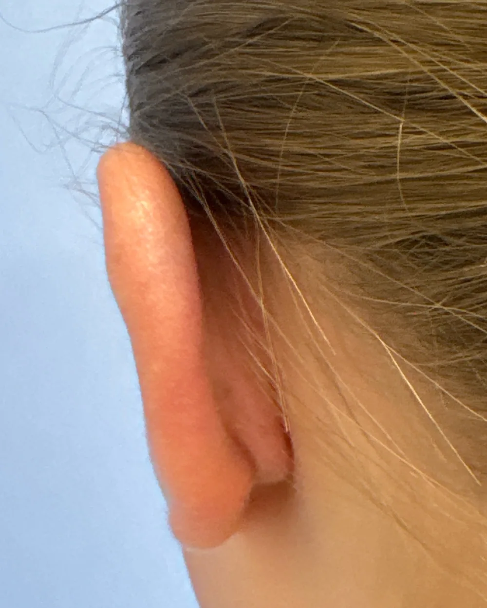 Behind the left ear, after surgery