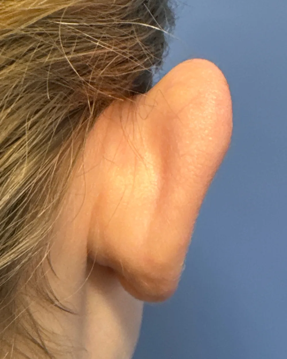 Behind the right ear, before surgery