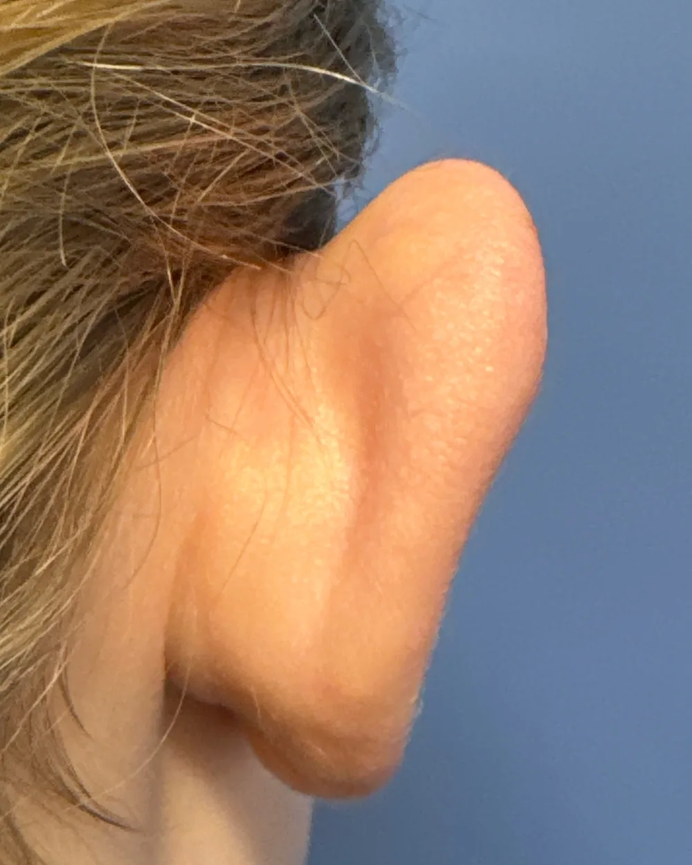 Behind the right ear, before surgery