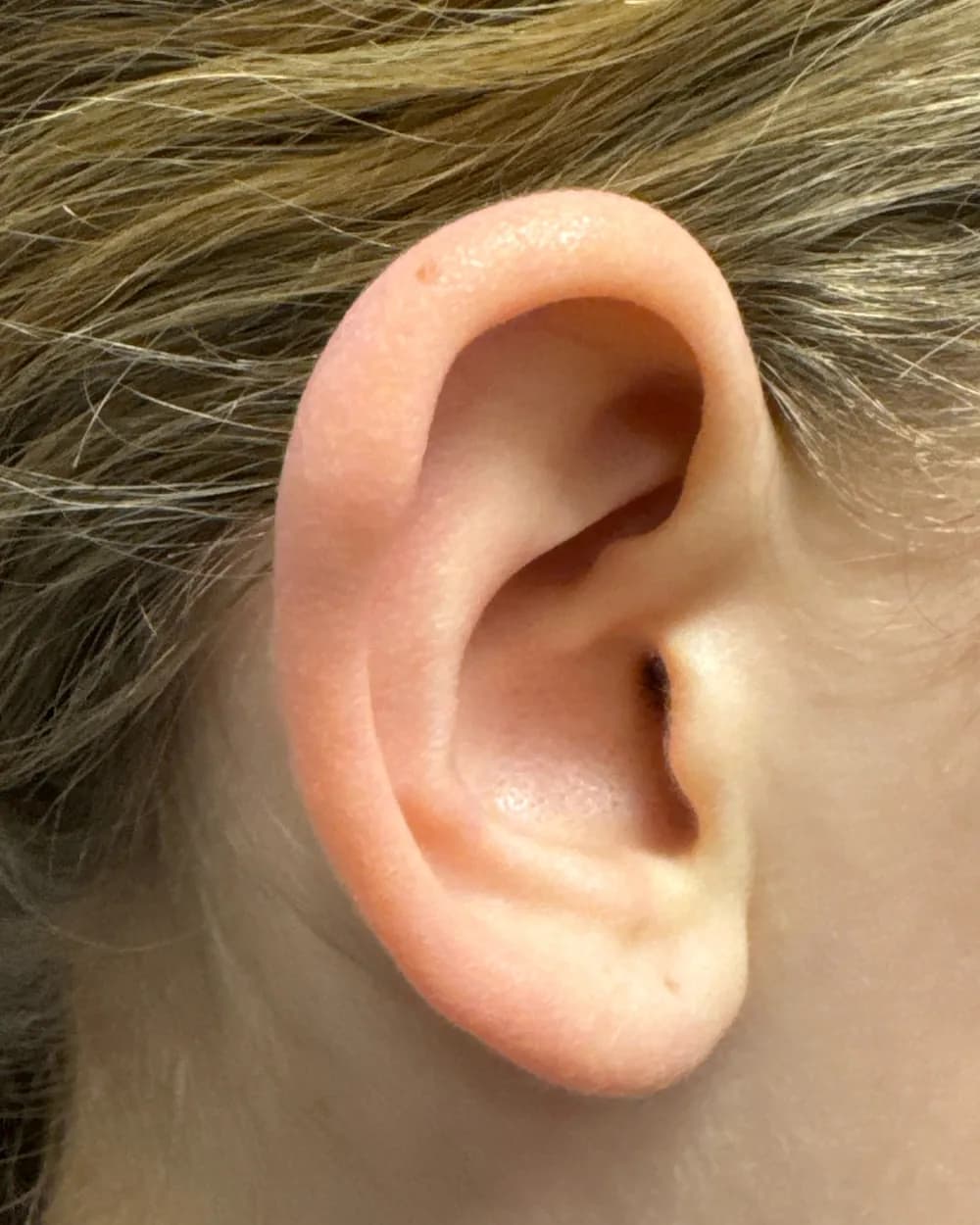 Right ear, from the side, before surgery