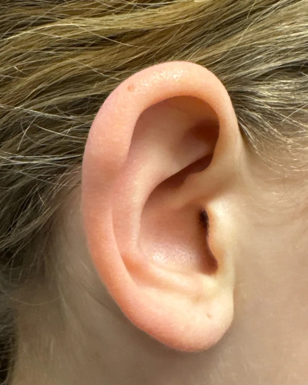 Right ear, from the side, before surgery