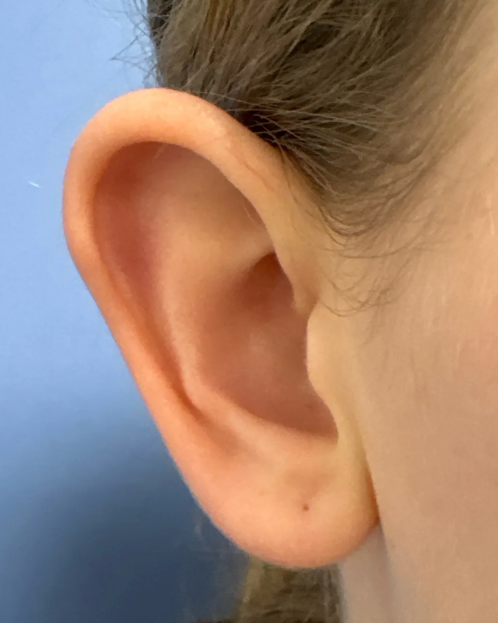Right ear, from the front, before surgery