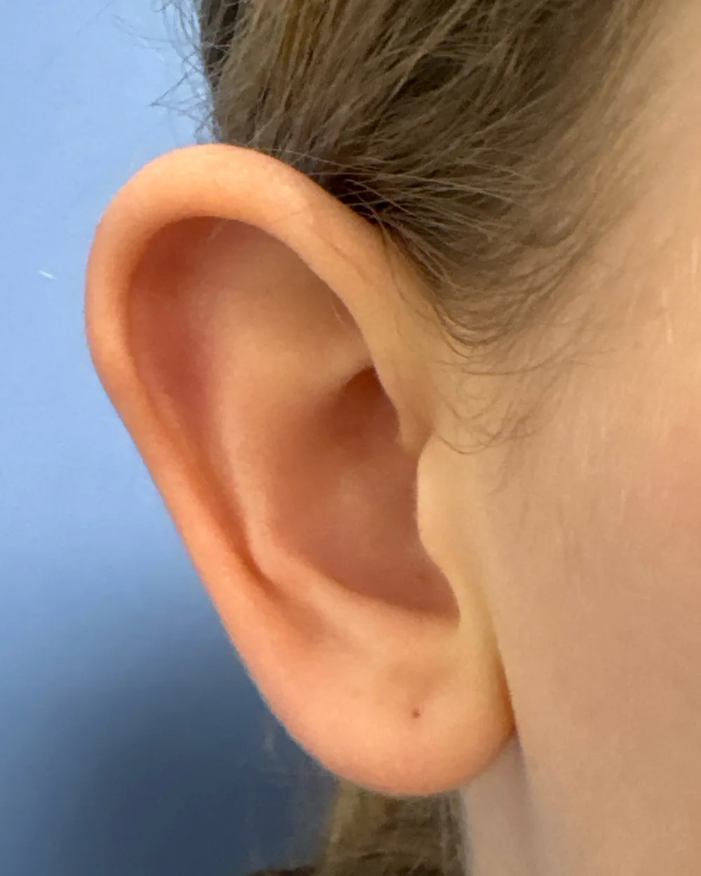 Right ear, from the front, before surgery