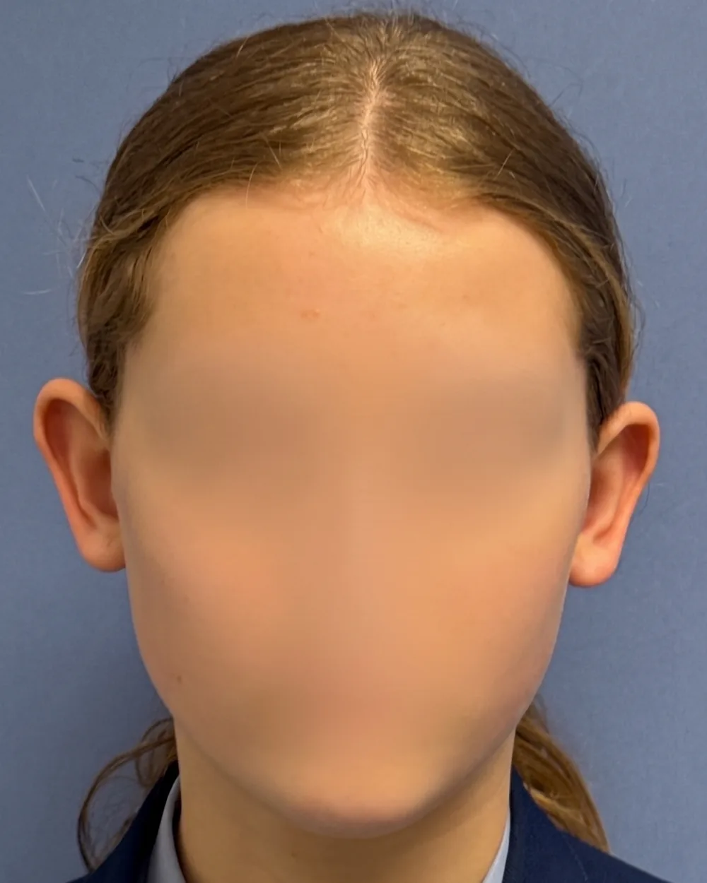 Face on, before surgery