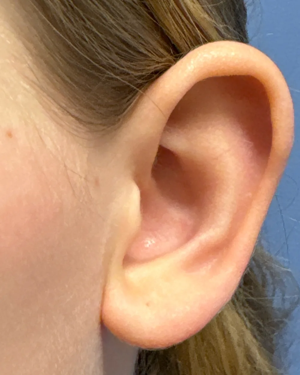 Left ear, from the front, before surgery