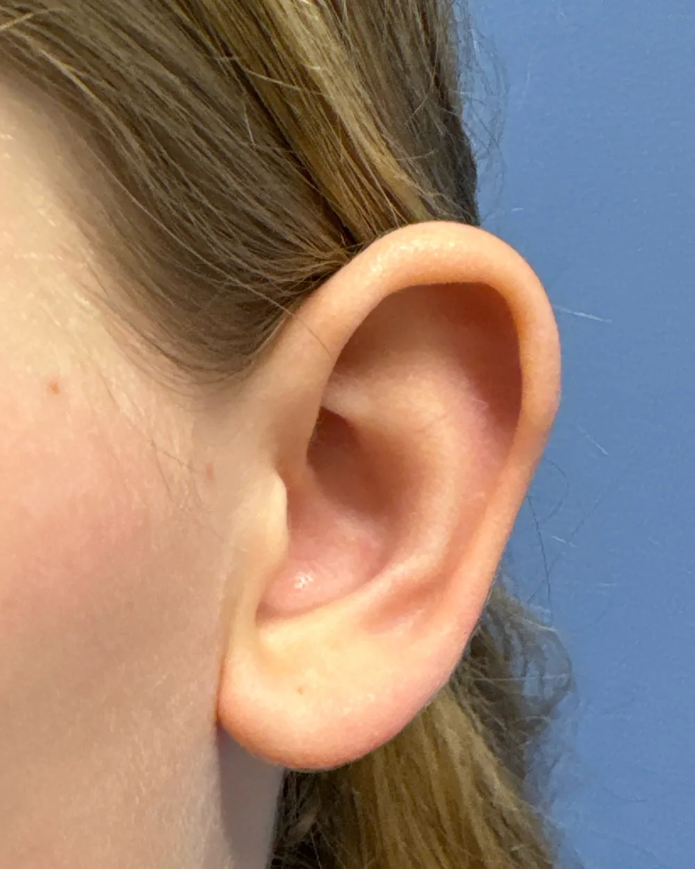 Left ear, from the front, before surgery