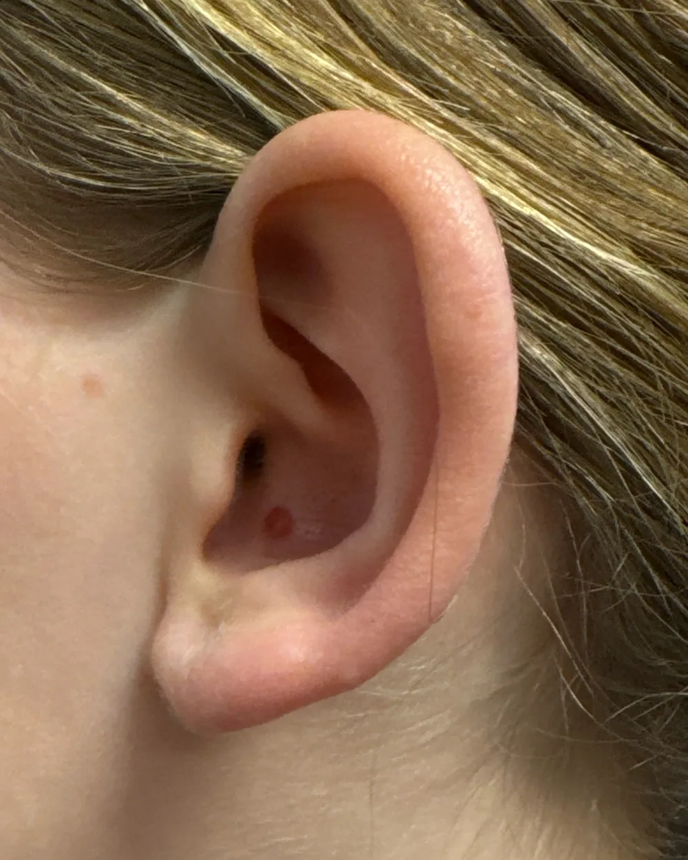 Left ear, from the side, before surgery