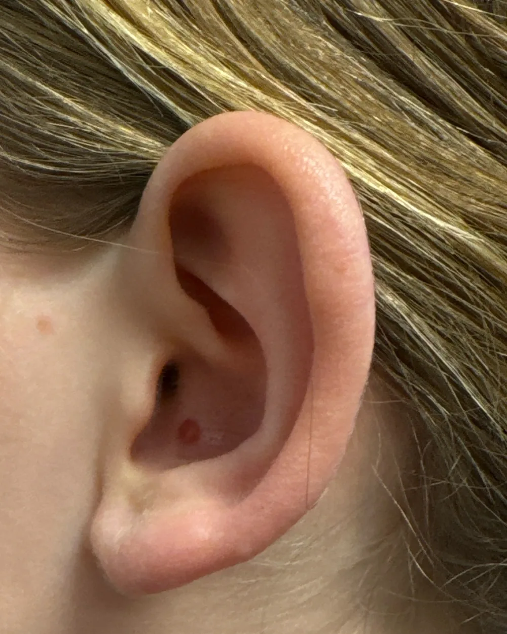 Left ear, from the side, before surgery