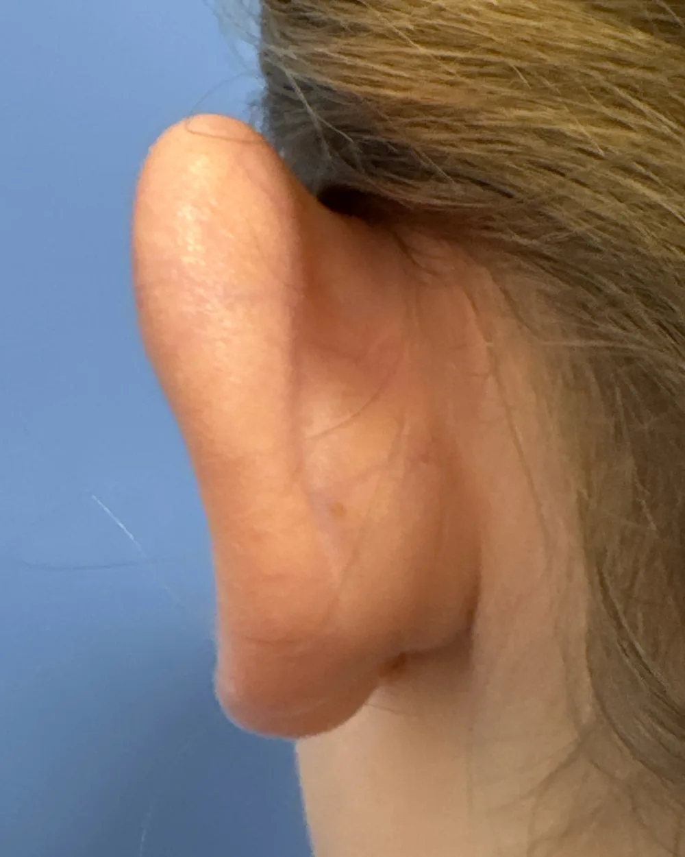 Behind the left ear, before surgery